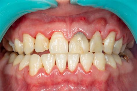 periodontal near me|Periodontal Disease (Gum Disease) .